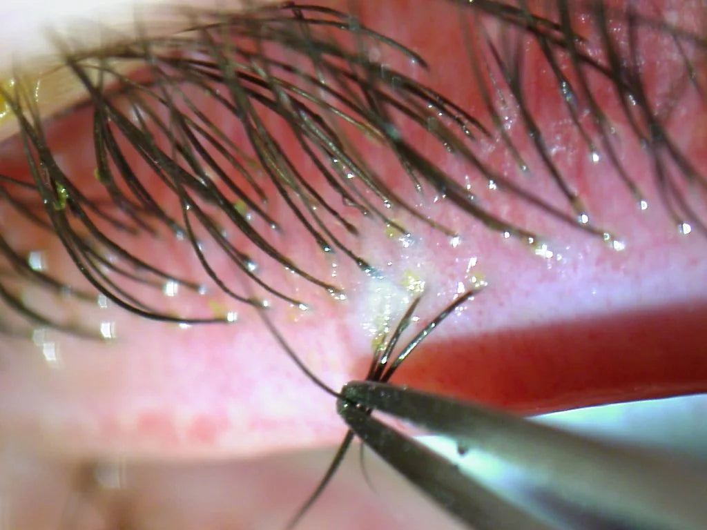 DEMODEX FOLLICULORUM