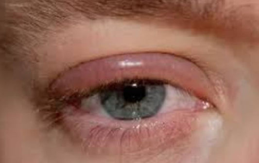 COMMENT FAIRE LA DIFFÉRENCE ENTRE ALLERGIE ET IRRITATION